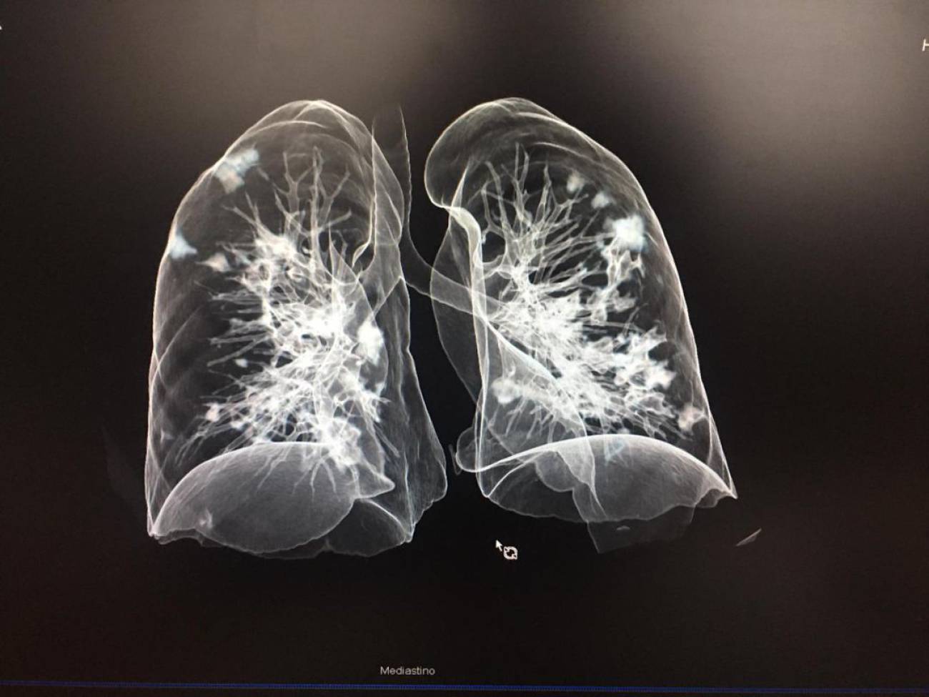 Radiografías como detección del Covid-19 en México